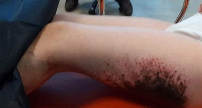 Kar topu sonrası vücudunda yanıklar oluşan 9 çocukla ilgili rapor bekleniyor