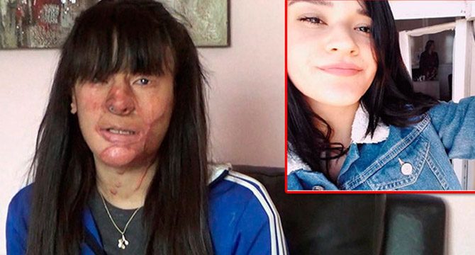 Berfin'e asitli saldırıda bulunan Casim Ozan Çeltik'e 13,5 yıl hapis