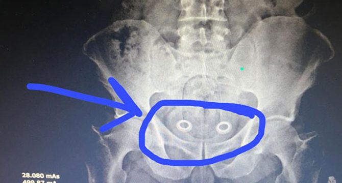 Bağırsağındaki uyuşturucu röntgende ortaya çıktı