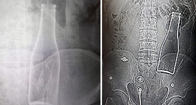 Karın ağrısı şikayetiyle gittiği hastanede, vücudunda şişe olduğu ortaya çıktı