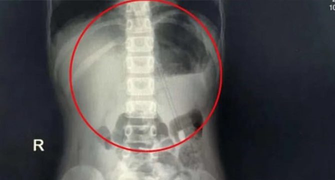 Çin'de 7 yaşındaki bir çocuğun boğazından 18 cm´lik kalem çıkartıldı