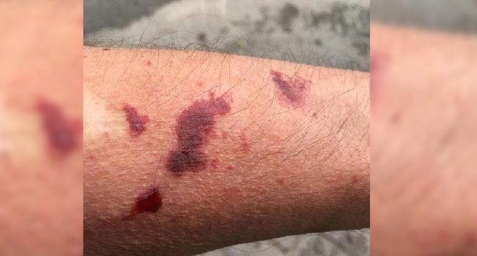Sapanca'da, Asya kaplan sivrisineği paniği