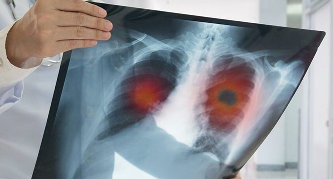 Türkiye'de yılda 185 bin kişi kanser oluyor