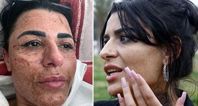 Yüzü yanan genç kız: Sosyal medyadaki reklamlarına kandım
