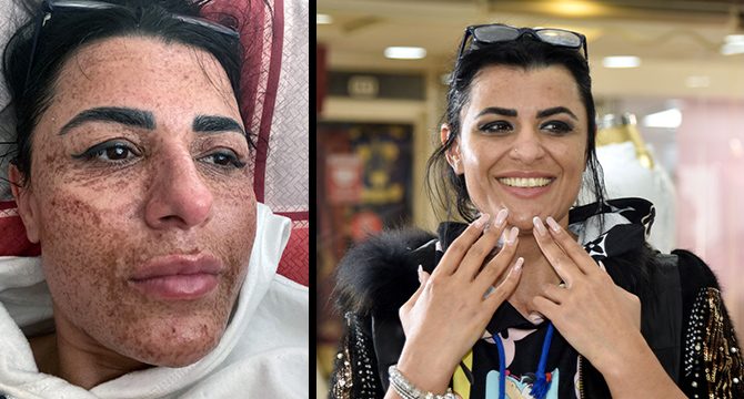 Estetik uğruna yüzü yanan kadın, aynalarla barıştı