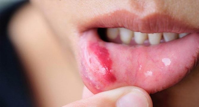 Uzmanı uyardı: Ağızdaki yaralar dil kanseri işareti olabilir