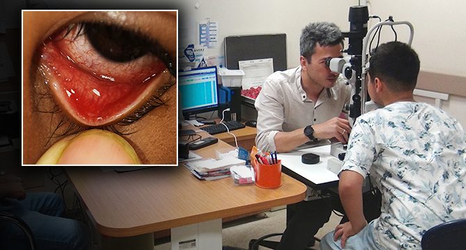 Bitlis'te çocuğun gözünden 11 sinek larvası çıkarıldı